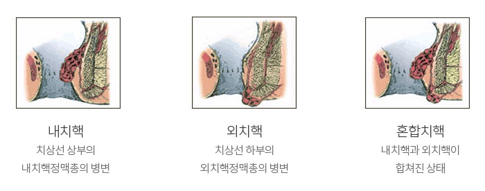 내치핵 / 외치핵 / 혼합치핵