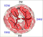 치핵 근본 수술 사진1