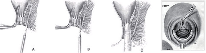 내괄약근 절개술 의 수기