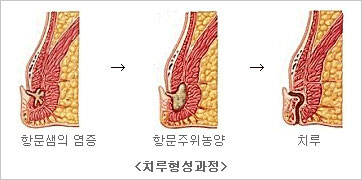 치루형성과정