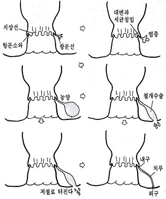 치루형성과정