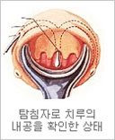 탐침자로 치루의 내공을 확인한 상태