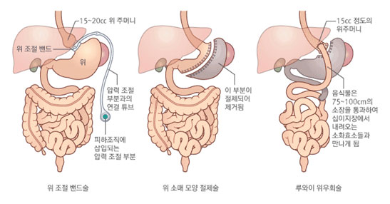 위 조절 밴드술 / 위 소매 모양 절제술 / 루와이 위우회술