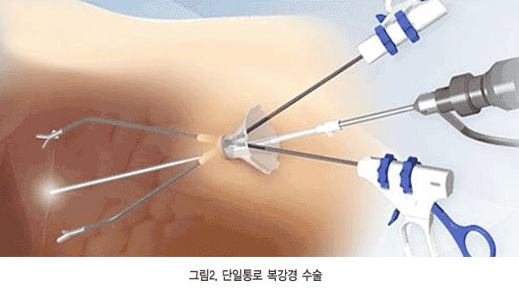 단일통로 복강경 수술