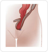 서혜부 탈장 (inguinal hernia)