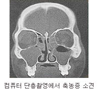 컴퓨터 단층촬영에서 충농증 소견