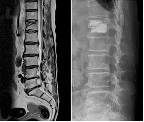 골다공증성 척추 압박 골절 치료 사진