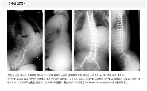 후종인대 골화증 사진