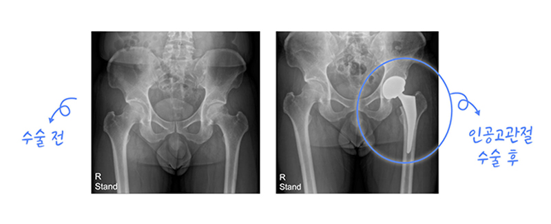 대퇴골두 무혈성 괴사 사진