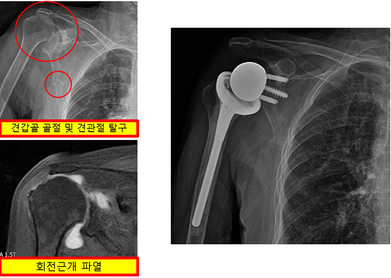 견관절 인공관절치환술 증례 사진