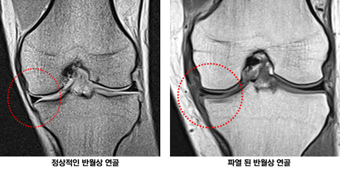 반월상 연골 파열 사진1