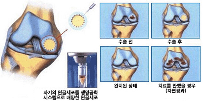 내시경 자가 연골 이식술 사진1