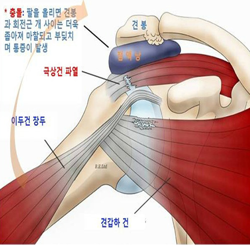 충돌증후군 사진1