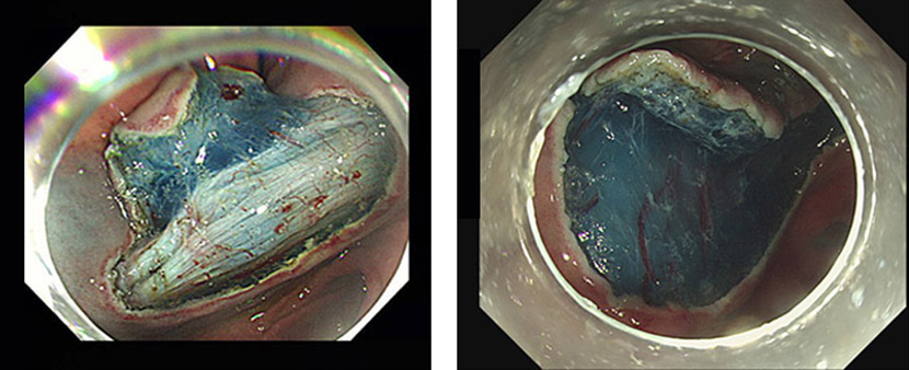 내시경적 점막하 박리술 사진