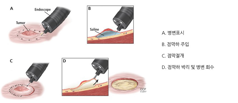 내시경적 점막하 박리술 시술 과정 사진