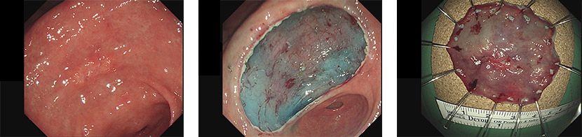 위 내시경 점막하 박리술 사진