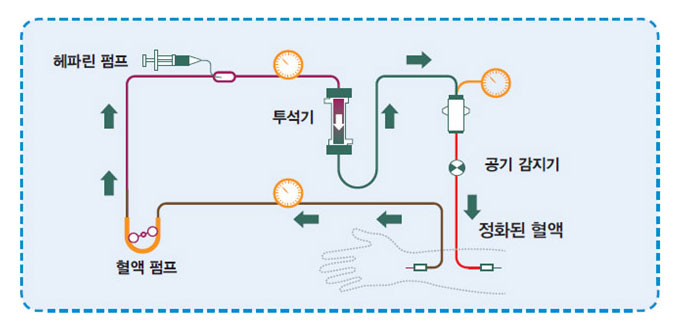 투석 과정 사진1