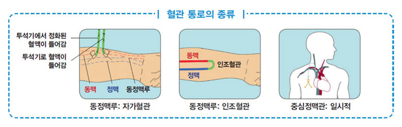 혈관 통로의 종류 사진